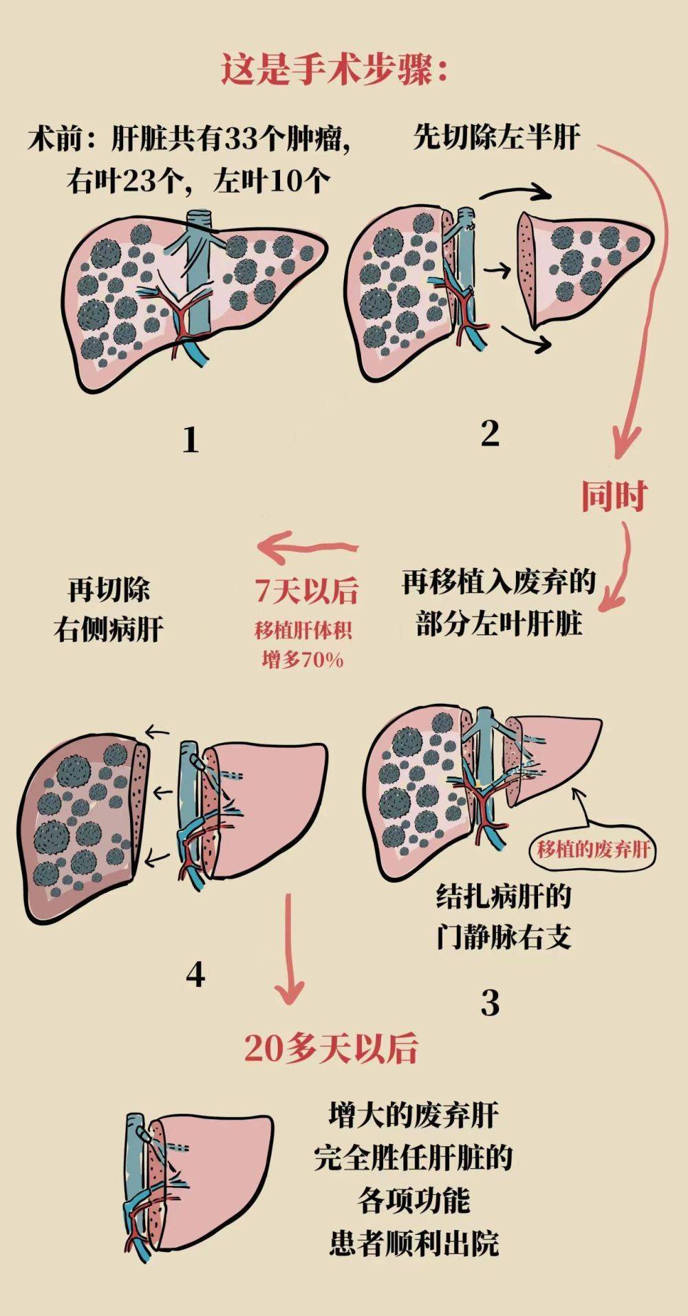 晚期肝癌最新疗法