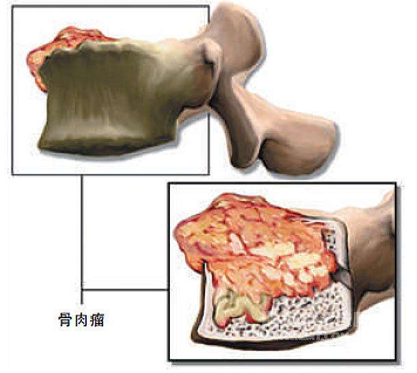 骨肉瘤最新治疗